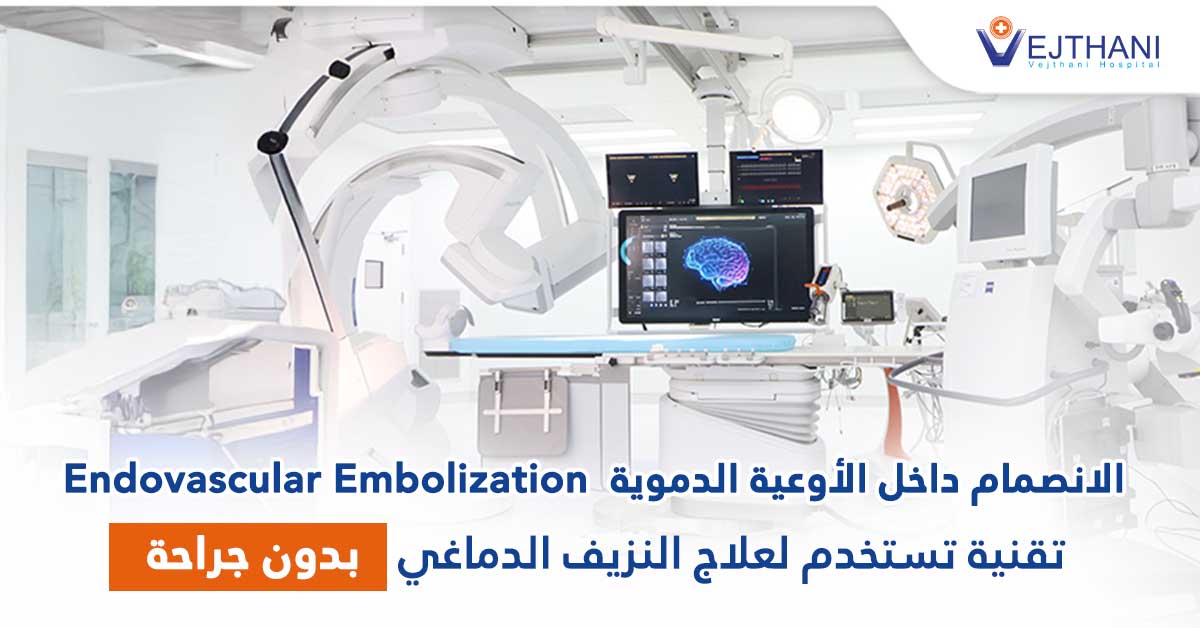 الانصمام داخل الأوعية الدموية، تقنية تستخدم لعلاج النزيف الدماغي بدون جراحة