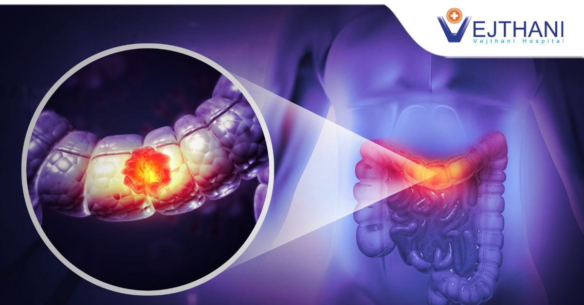 Colonoscopy: Your Key to Colon Cancer Prevention
